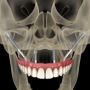 Looking for Zygomatic Implant? Get Advanced Treatments