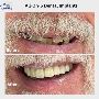 Looking for Full-Mouth Restoration? Explore All-on-6 Dental 