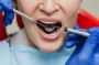 Chipped Tooth Treatment – 7 Day Dentist