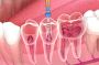 Root Canal Treatments – Gentle Care at 7 Day Dentist