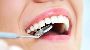 White Fillings Dentist – Natural Smile Care at 7 Day Dentist