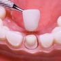 Dental Crowns Replaced – Expert Care at 7 Day Dentist