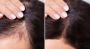 Say Goodbye To Hair Loss: Effective Treatments A2Z RX
