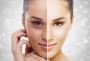 Pigmentation Treatment in Guwahati - Sculpt India