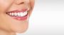 Teeth Whitening - Restore the Natural Shade of Your Teeth