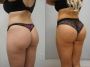 Brazilian Butt Lift NY Sculpt Your Ideal Figure