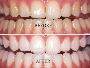 Best Teeth Whitening Mississauga