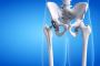 Revision Hip Replacement by Dr. Ajaysinh Devda