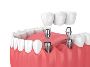 Transform Your Smile with a Complete Teeth Set at Akeela Den