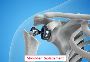 Shoulder Replacement Treatment