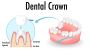 Restore Your Smile with Durable Dental Crowns