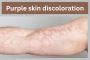 Purple Skin Discoloration: What You Need to Know