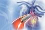 Do Stents and Bypass Surgery Cure Heart Disease? The Truth
