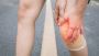 How to Treat and Prevent Vein Pain in Leg