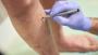 Exploring Alternatives to Sclerotherapy for Vein Treatment