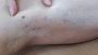 How to prevent and treat varicose bleeding?