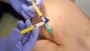 Do reticular varicose veins Need Treatment?