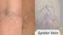 Transform Your Skin: Benefits of Laser Spider Vein Removal