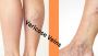 How to Determine If Your Varicose Veins Are Genetic?