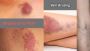 When Should You Worry About a Bruise on a Vein?