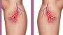 Can You Die from a Burst Varicose Vein: Myths vs. Facts?