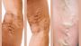 Why Are My Veins So Prominent? Understanding the Causes
