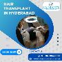 Find Best Hair Treatment Hospital in Hyderabad