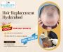 Hair Replacement Services in Hyderabad