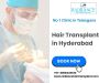 Hair Transplant in Hyderabad