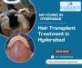 Hair Transplant Treatment in Hyderabad