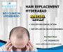 Top Hair Replacement Clinic in Hyderabad