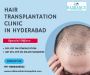 Affordable Hair Transplantation Clinic in Hyderabad
