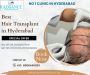 Best Hair Transplant in Hyderabad | Natural & Lasting Result