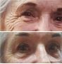 Face lifting in Upper Mount Gravatt
