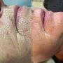 Microneedling: Rejuvenate Skin & Boost Collagen Production
