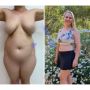 Butt Augmentation Surgery in Thailand