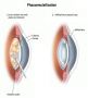 Best Phacoemulsification Treatment In Delhi
