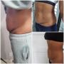  Non-Surgical Body Treatments in Bay Park