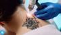  Tattoo Removal in Regina: A Comprehensive Guide to Regainin