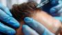  Say Goodbye to Hair Loss with PRP
