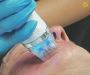  MNRF Treatment in Bangalore for Anti-Aging Solution