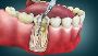 Gentle & Effective Root Canal Therapy at Cliftonville Dental