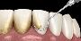 Say Goodbye to Bleeding Gums with Cliftonville’s Expert Hygi