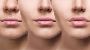 Cliftonville Dental – Trusted Lip Filler Northampton Clinic
