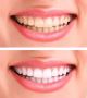 Teeth Whitening in Thane | Creative Smiles