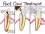 Root Canal Specialist in Lewisville,TX
