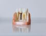 Expert Care for Missing Teeth – Dental Implants in Sydney