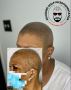 Scalp Micropigmentation for Men: Restore Your Confidence