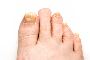 Laser Toenail Treatment in Houston: Safe, Effective, and Pai