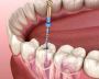 The Dental Wellness Center - Trusted Root Canal Services Nea